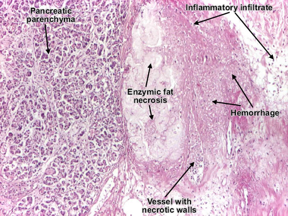 Acute pancreatitis (Acute hemorrhagic pancreatic necrosis)