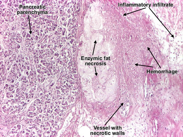 Acute pancreatitis (Acute hemorrhagic pancreatic necrosis) Acute pancreatitis (Acute hemorrhagic pancreatic necrosis)