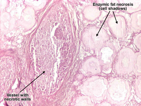 Acute pancreatitis (Acute hemorrhagic pancreatic necrosis)