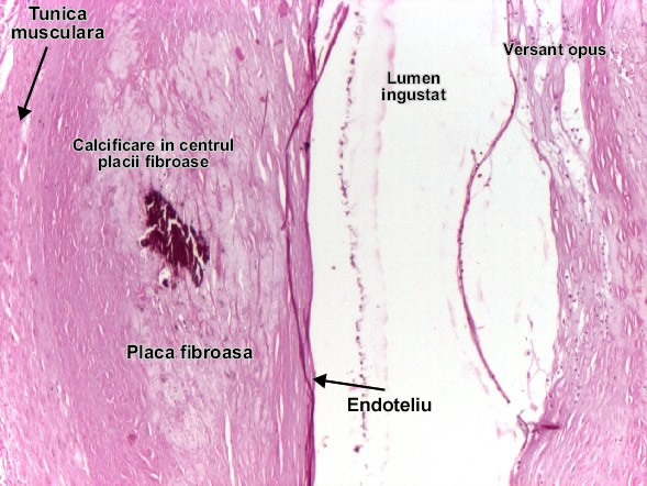 Ateroscleroza coronariana - Placa fibroasa calcificata