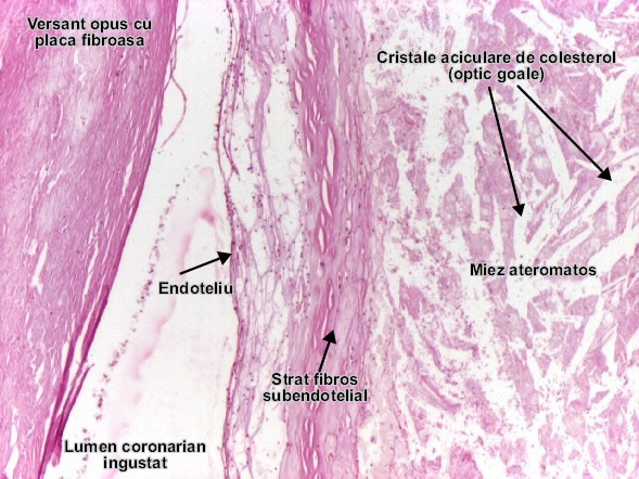 Ateroscleroza coronariana - Placa fibrolipidica
