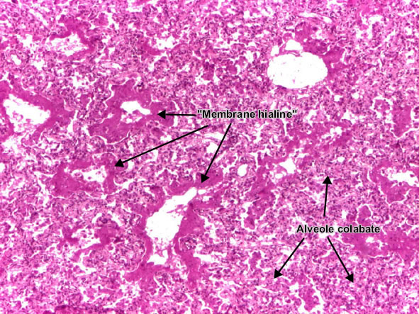 Boala membranelor hialine