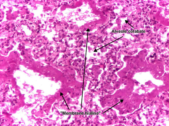 Boala membranelor hialine (detaliu 1)