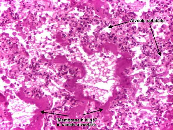 Boala membranelor hialine (detaliu 2)