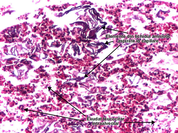 Bronhoneumonia de aspiratie (2)