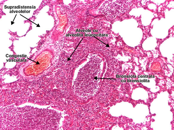 Bronhoneumonia (Pneumonia lobulara)
