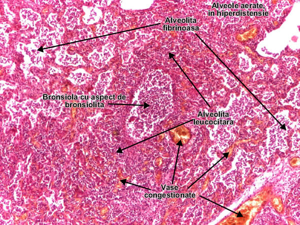 Bronhoneumonia (Pneumonia lobulara)