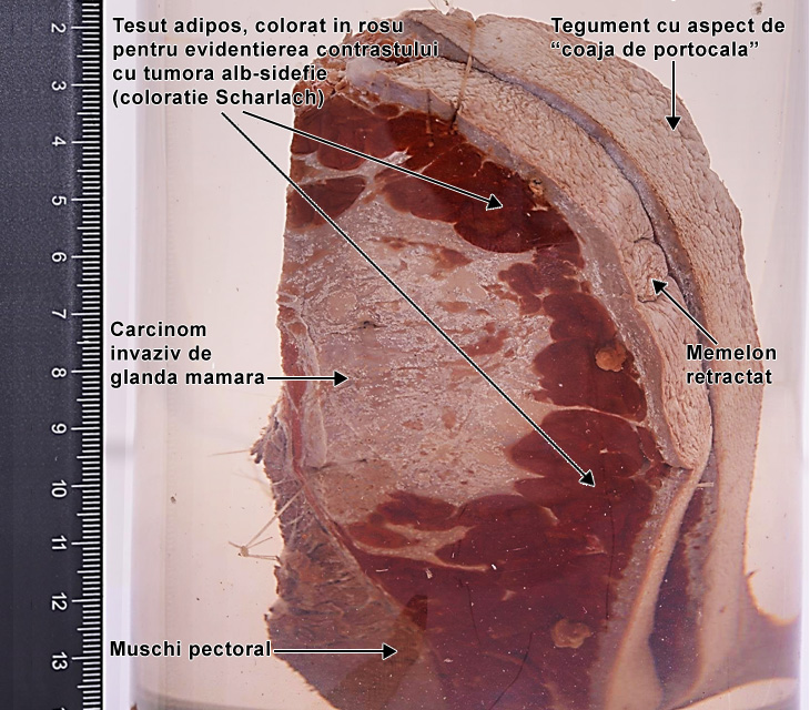 Carcinomul invaziv glanda mamara