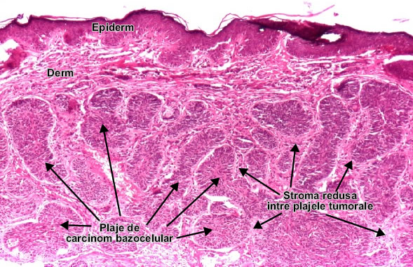 Carcinomul bazocelular