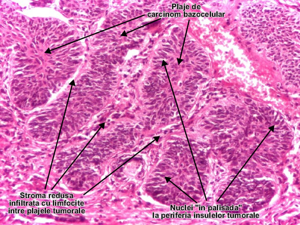 Carcinomul bazocelular palisada