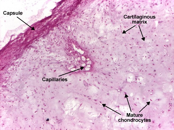 Chondroma