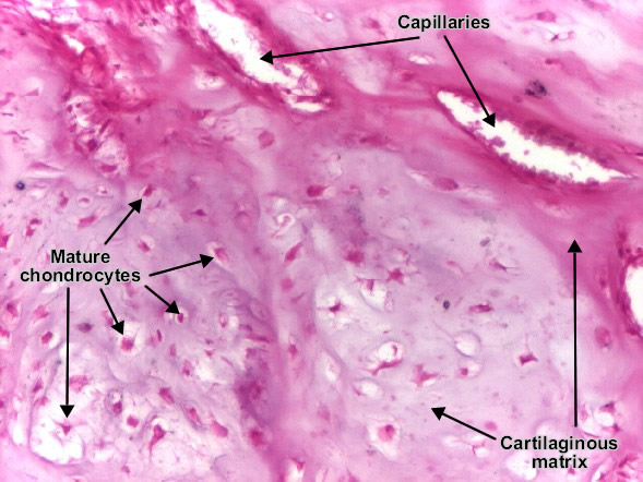 Chondroma (detail)