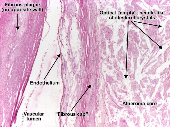 Coronary atherosclerosis - fibro fatty plaque