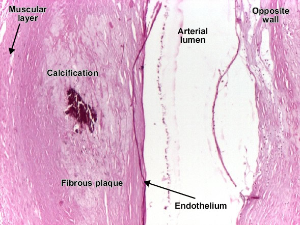 Coronary atherosclerosis - the fibrous plaque with calcification Coronary atherosclerosis - the fibrous plaque with calcification