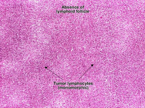 Diffuse lymphocytic non-Hodgkin lymphoma