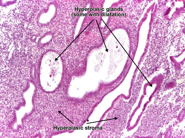 Simple typical hyperplasia of endometrium