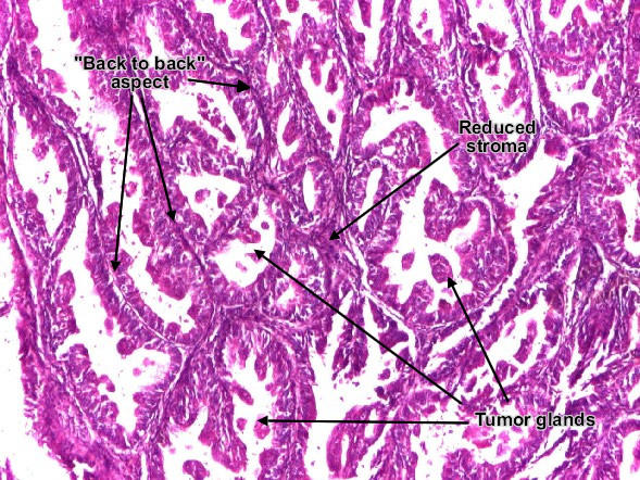 Endometrioid carcinoma of endometrium (detail)