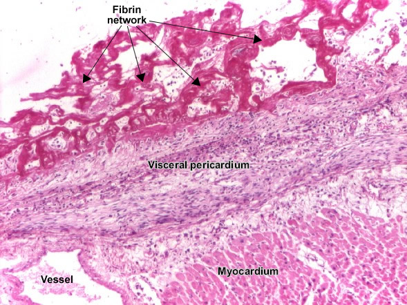 Fibrinous pericarditis