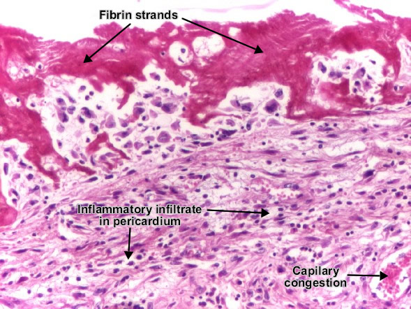 Fibrinous pericarditis - detail