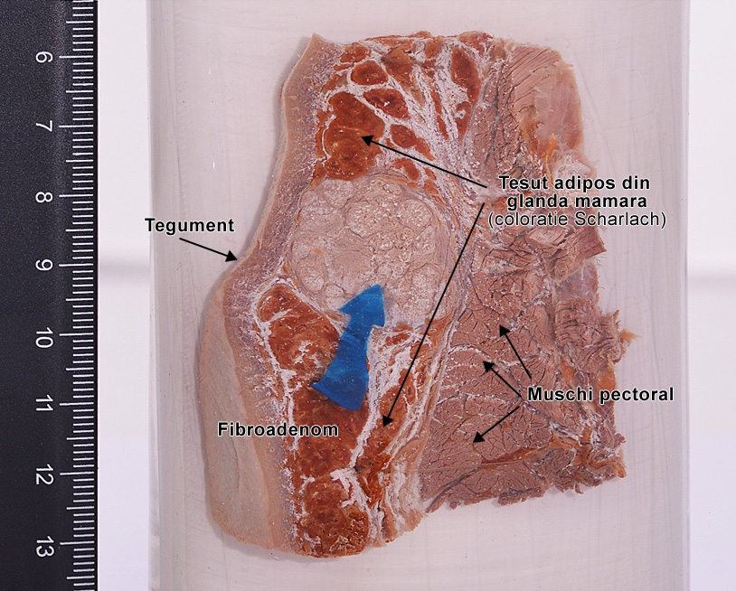 Fibroadenom glanda mamara (macroscopic)