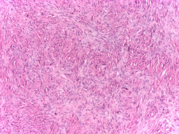 Fibrosarcoma