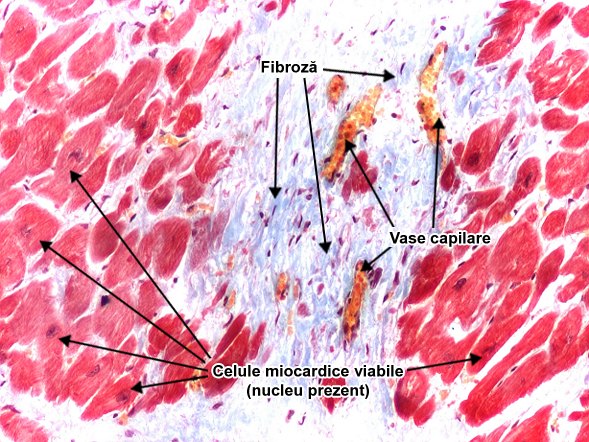 Fibroza ischemica a miocardului