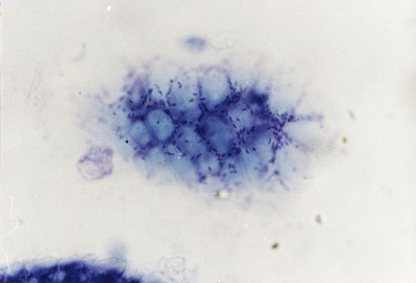 Gastritis Helicobacter pylori