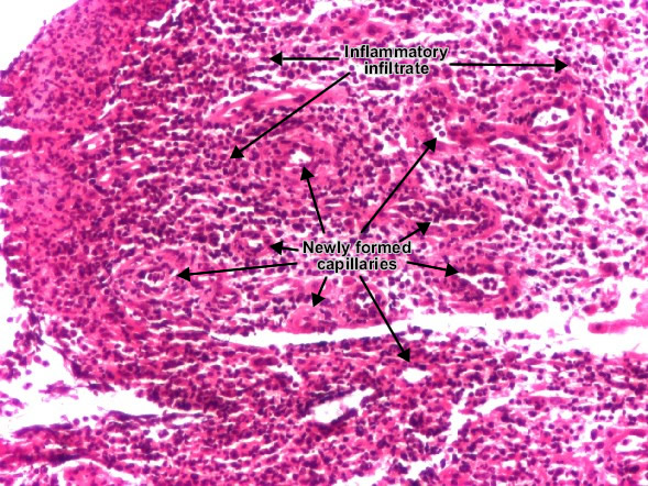 Granulation tissue