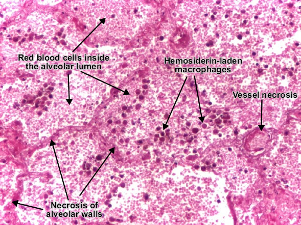 hemorrhagic