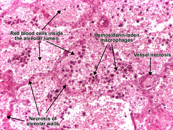 Hemorrhagic infarct lung (detail)