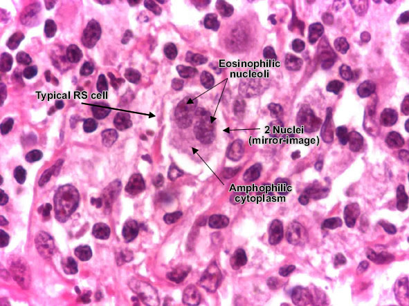 Hodgkin lymphoma, Reed-Sternberg cell