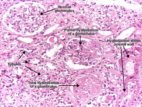 Hyaline arteriolosclerosis