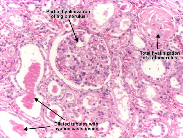 Hyaline arteriolosclerosis Hyaline arteriolosclerosis