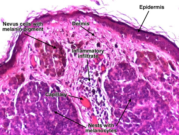 Intradermal melanocytic nevus (detail)