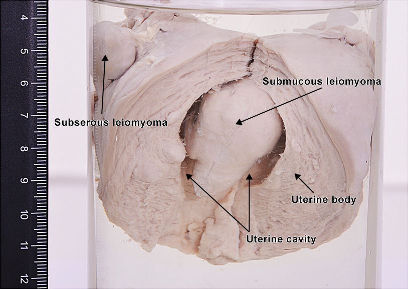 Leiomyoma (uterus)