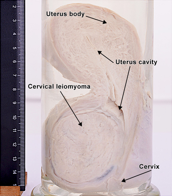 Leiomyoma (uterus)