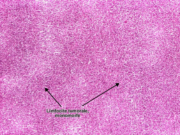 Limfomul malign non-Hodgkin limfocitic