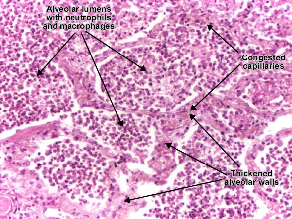 Lobar pneumonia (leukocytic alveolitis) Lobar pneumonia (leukocytic alveolitis)
