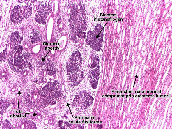 Nefroblastomul (Tumora Wilms)