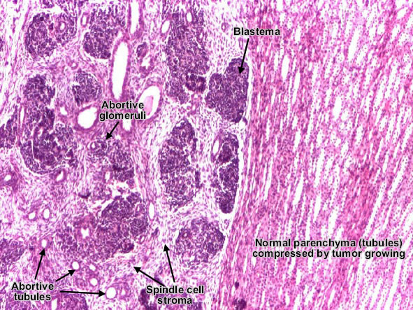 Nephroblastoma (Wilms' Tumor)