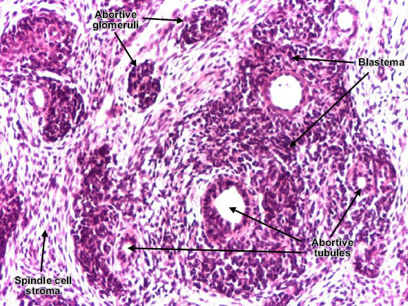 Nephroblastoma (Wilms' Tumor) (detail)