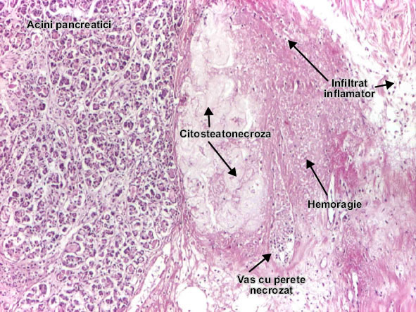 Pancreatita acuta necrotico hemoragica