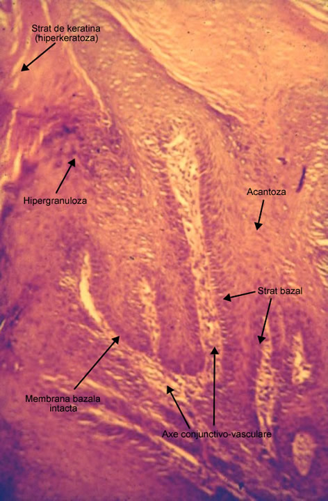 Papilomul scuamocelular piele cutanat
