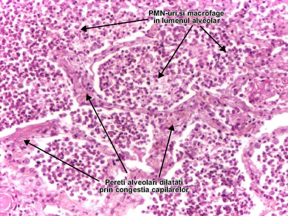Pneumonia lobara (alveolita leucocitara)