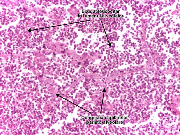 Pneumonia lobara (alveolita leucocitara)