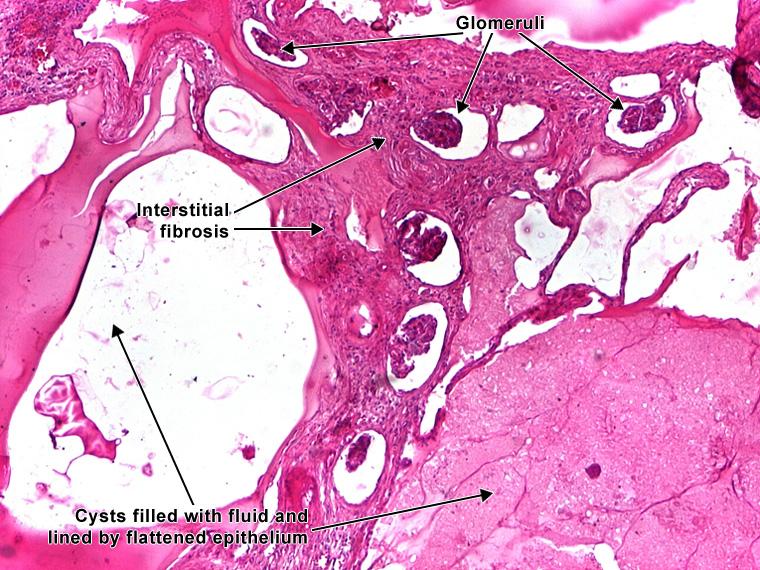 Polycystic Kidney - microscopy