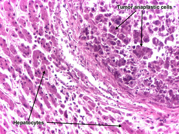 Poorly differentiated hepatocellular carcinoma