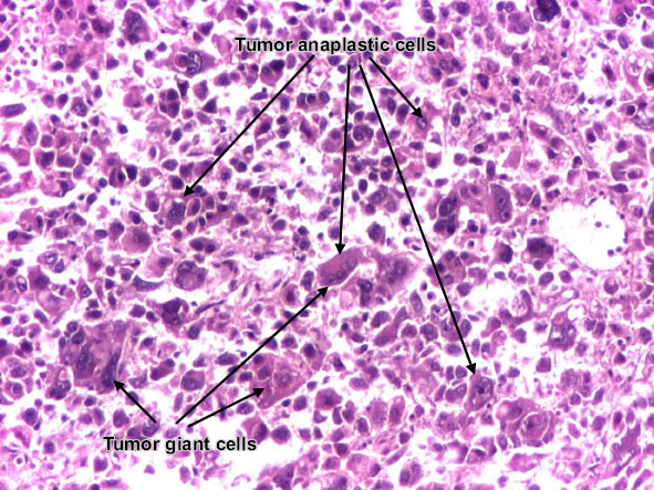 Poorly differentiated hepatocellular carcinoma (detail)