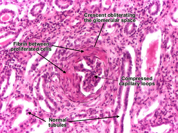 Rapidly progressive crescentic glomerulonephritis