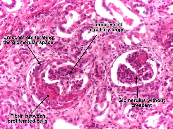 Rapidly progressive crescentic glomerulonephritis (02) Rapidly progressive crescentic glomerulonephritis (02)
